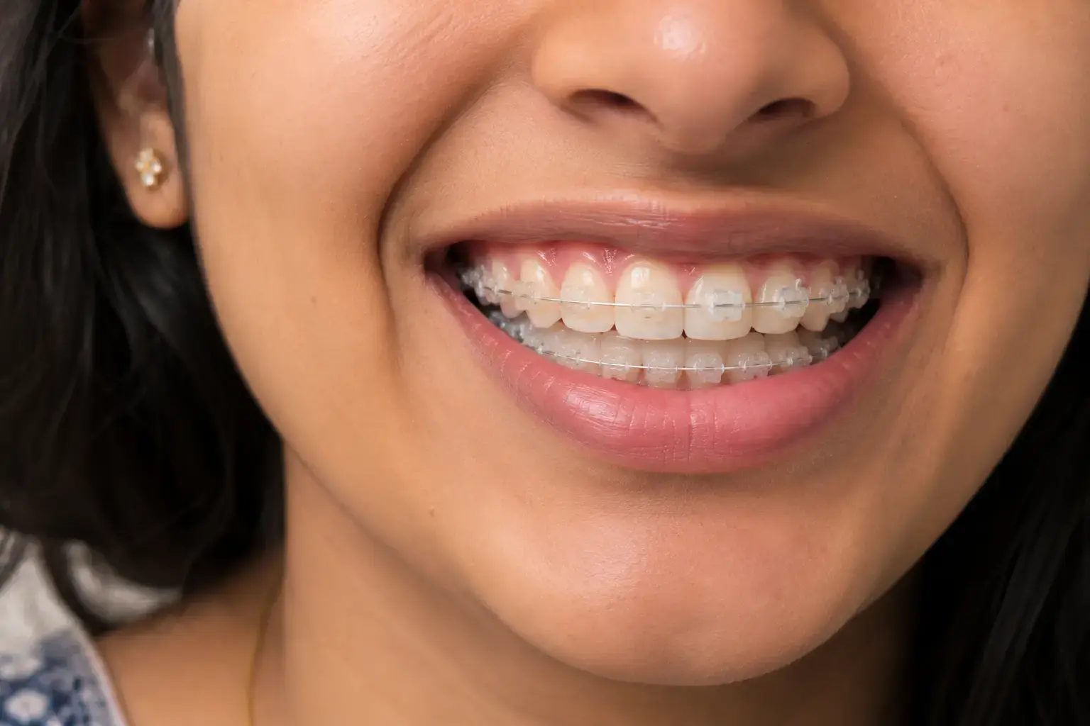 Close-up of aesthetic braces treatment using dental laser equipment